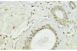 Immunohistochemistry of paraffin-embedded Human breast using Snail Polyclonal Antibody at dilution of 1:100 (40x lens). (SNAIL Antikörper)