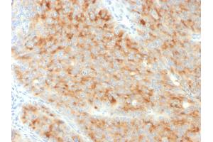 Formalin-fixed, paraffin-embedded human Pancreatic Carcinoma stained with Synaptophysin-Monospecific Mouse Monoclonal Antibody (SYP/3551). (MSH2 Antikörper  (AA 224-313))