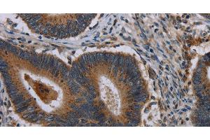 Immunohistochemistry of paraffin-embedded Human colon cancer using MAP3K11 Polyclonal Antibody at dilution of 1:40 (MAP3K11 Antikörper)