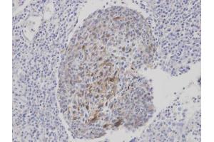 IHC-P Image Immunohistochemical analysis of paraffin-embedded human gastric cancer, using CLCA1, antibody at 1:100 dilution. (CLCA1 Antikörper)