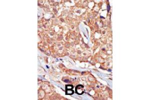 Formalin-fixed and paraffin-embedded human cancer tissue reacted with TRPM6 polyclonal antibody  , which was peroxidase-conjugated to the secondary antibody, followed by AEC staining. (TRPM6 Antikörper  (Internal Region))