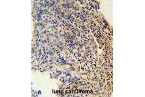 ZNF197 antibody (N-term) immunohistochemistry analysis in formalin fixed and paraffin embedded human lung carcinoma followed by peroxidase conjugation of the secondary antibody and DAB staining.