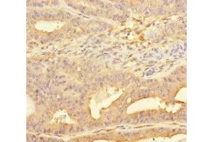 Immunohistochemistry of paraffin-embedded human endometrial cancer using ABIN7158455 at dilution of 1:100 (PPFIA1 Antikörper  (AA 660-800))
