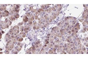 ABIN6273224 at 1/100 staining Human pancreas cancer tissue by IHC-P. (DAAM1 Antikörper  (Internal Region))