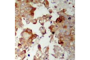 Immunohistochemical analysis of MRPS17 staining in human prostate cancer formalin fixed paraffin embedded tissue section. (MRPS17 Antikörper  (N-Term))