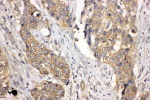 Anti-LASP1 antibody, IHC(P) IHC(P): Human Lung Cancer Tissue (LASP1 Antikörper  (N-Term))