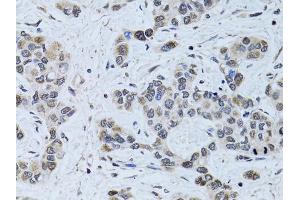 Immunohistochemistry of paraffin-embedded human liver cancer using SIN3A antibody. (SIN3A Antikörper)