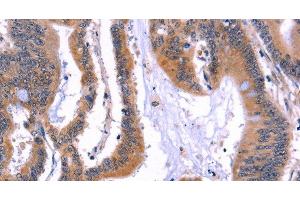 Immunohistochemistry of paraffin-embedded Human colon cancer using ARC Polyclonal Antibody at dilution of 1:50 (ARC Antikörper)
