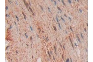 Detection of FADD in Human Stomach cancer Tissue using Polyclonal Antibody to Fas Associating Death Domain Containing Protein (FADD) (FADD Antikörper  (AA 12-206))