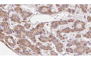 ABIN6272676 at 1/100 staining Human liver cancer tissue by IHC-P. (BAI3 Antikörper  (Internal Region))