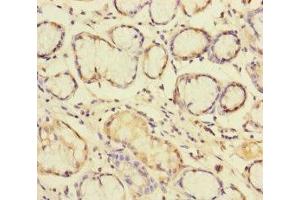 Immunohistochemistry of paraffin-embedded human gastric cancer using ABIN7145609 at dilution of 1:100 (Pallidin Antikörper  (AA 1-170))