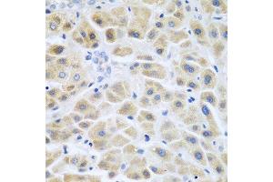 Immunohistochemistry of paraffin-embedded human liver cancer using ACCS antibody at dilution of 1:200 (40x lens).