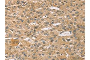 The image on the left is immunohistochemistry of paraffin-embedded Human liver cancer tissue using ABIN7192633(SPON1 Antibody) at dilution 1/30, on the right is treated with synthetic peptide. (SPON1 Antikörper)