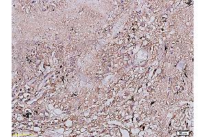 Formalin-fixed and paraffin embedded human lung carcinoma labeled with Anti-EGFR Polyclonal Antibody, Unconjugated (ABIN725720) at 1:200 followed by conjugation to the secondary antibody and DAB staining (EGFR Antikörper  (AA 951-1050))