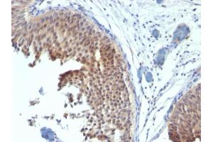 Formalin-fixed, paraffin-embedded human Bladder Carcinoma stained with Cytokeratin 6 Mouse Monoclonal Antibody (SPM269). (KRT6A/KRT6B/KRT6C (C-Term) Antikörper)