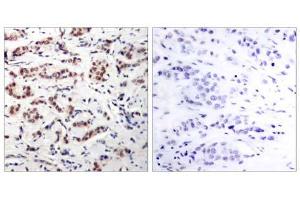 Immunohistochemical analysis of paraffin-embedded human breast carcinoma tissue using STAT5A (phospho-Tyr694) antibody (E011048). (STAT5A Antikörper  (pTyr694))