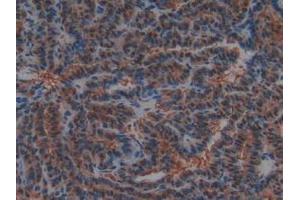 IHC-P analysis of Human Thyroid Cancer Tissue, with DAB staining. (PTF1A Antikörper  (AA 177-328))