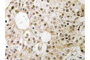 Immunohistochemistry (IHC) analyzes of CD3EAP antibody in paraffin-embedded human breast carcinoma tissue. (CD3EAP Antikörper)