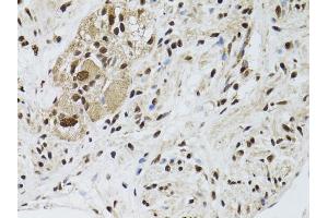 Immunohistochemistry of paraffin-embedded human colon carcinoma using STK11 antibody. (LKB1 Antikörper)