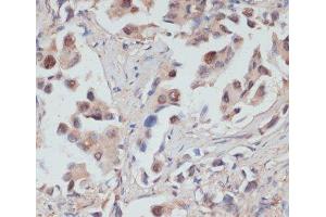 Immunohistochemistry of paraffin-embedded Human lung cancer using TES Polyclonal Antibody at dilution of 1:100 (40x lens).