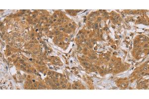 Immunohistochemistry of paraffin-embedded Human cervical cancer tissue using KCNJ15 Polyclonal Antibody at dilution 1:40 (KCNJ15 Antikörper)