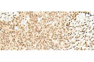 Immunohistochemistry of paraffin-embedded Human ovarian cancer tissue using FKBP5 Polyclonal Antibody at dilution of 1:50(x200) (FKBP5 Antikörper)