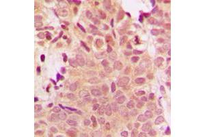 Immunohistochemical analysis of Histone Deacetylase 5 staining in human breast cancer formalin fixed paraffin embedded tissue section.
