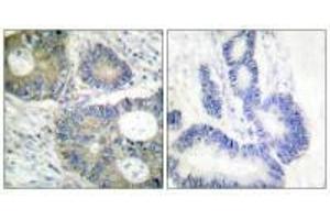 Immunohistochemical analysis of paraffin-embedded human colon carcinoma tissue using 4E-BP1 (Ab-64) antibody. (eIF4EBP1 Antikörper  (Ser65))
