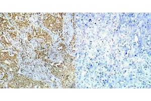 Immunohistochemical analysis of paraffin-embedded human breast carcinoma tissue using Abl1 (phospho- Tyr412) antibody (E012002). (ABL1 Antikörper  (pTyr412))