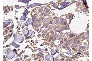 ABIN6267428 at 1/100 staining human breast carcinoma tissue sections by IHC-P. (NFKB1 Antikörper  (pSer927))