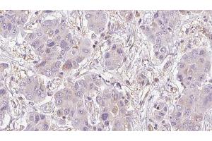 ABIN6273951 at 1/100 staining Human liver cancer tissue by IHC-P. (NMUR2 Antikörper  (C-Term))