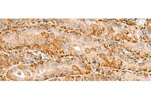 Immunohistochemistry of paraffin-embedded Human thyroid cancer tissue using C3orf38 Polyclonal Antibody at dilution of 1:80(x200)