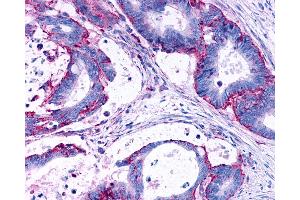 Anti-LPAR3 / LPA3 / EDG7 antibody IHC of human Colon, Carcinoma. (LPAR3 Antikörper  (Cytoplasmic Domain))