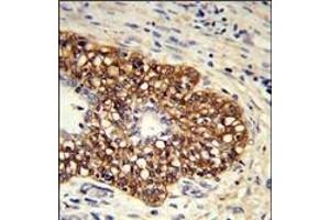 Formalin-fixed and paraffin-embedded human prostate carcinoma reacted with CYP8A1 Antibody (C-term) (ABIN652421 and ABIN2842087) , which was peroxidase-conjugated to the secondary antibody, followed by DAB staining. (PTGIS Antikörper  (C-Term))