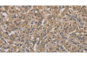Immunohistochemistry of paraffin-embedded Human thyroid cancer tissue using AGTRAP Polyclonal Antibody at dilution 1:40 (AGTRAP Antikörper)
