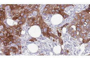 ABIN6272640 at 1/100 staining Human Head and neck cancer tissue by IHC-P.