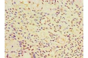 Immunohistochemistry of paraffin-embedded human breast cancer using ABIN7146575 at dilution of 1:100 (Calreticulin 3 Antikörper  (AA 135-384))
