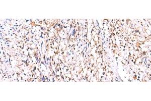 Immunohistochemistry of paraffin-embedded Human cervical cancer tissue using GMDS Polyclonal Antibody at dilution of 1:70(x200) (GMDS Antikörper)