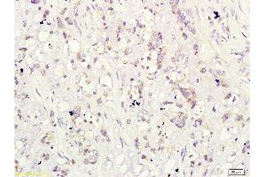 Formalin-fixed and paraffin-embedded human cervical carcinoma labeled with Rabbit Anti-CD160/By55 Polyclonal Antibody ( , Unconjugated at 1:200 followed by conjugation to the secondary antibody and DAB staining (CD160 Antikörper  (AA 81-159))
