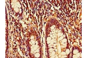 Immunohistochemistry of paraffin-embedded human colon cancer using ABIN7149691 at dilution of 1:100 (CDT2/RAMP Antikörper  (AA 393-550))