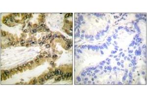 Immunohistochemistry analysis of paraffin-embedded human lung carcinoma, using Akt1 (Phospho-Thr450) Antibody.