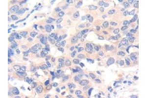 DAB staining on IHC-P; Samples: Human Breast cancer Tissue (IL-7 Antikörper  (AA 26-177))