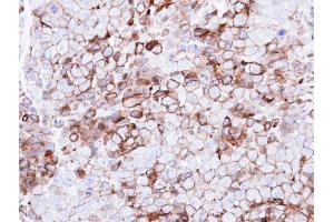 IHC-P Image Immunohistochemical analysis of paraffin-embedded CL1-0 xenograft, using GPR86, antibody at 1:500 dilution. (Purinergic Receptor P2Y, G-Protein Coupled, 13 (P2RY13) (Internal Region) Antikörper)