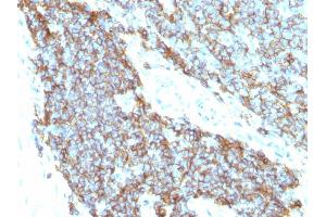 Formalin-fixed, paraffin-embedded human Ewing's sarcoma stained with CD99 Monoclonal Antibody (12E7+MIC2/877). (CD99 Antikörper)