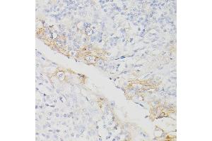 Immunohistochemistry of paraffin-embedded Human chronic tonsillitis using PD-L1/CD274/CD274 Rabbit mAb (ABIN7266181) at dilution of 1:200 (40x lens). (PD-L1 Antikörper  (Extracellular Domain))