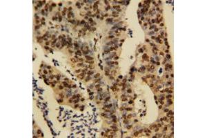 Immunohistochemical staining of human rectal cancer tissue with TNFAIP1 polyclonal antibody . (TNFAIP1 Antikörper  (N-Term))