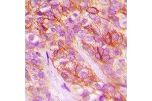 Immunohistochemical analysis of AT1 staining in human breast cancer formalin fixed paraffin embedded tissue section.