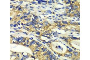 Immunohistochemistry of paraffin-embedded Human colon carcinoma using RPH3A Polyclonal Antibody at dilution of 1:100 (40x lens). (RPH3A Antikörper)