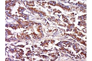 Formalin-fixed and paraffin embedded human lung carcinoma labeled with Anti-FAIM3 Polyclonal Antibody, Unconjugated  at 1:500 followed by conjugation to the secondary antibody and DAB staining. (FAIM3 Antikörper  (AA 51-150))