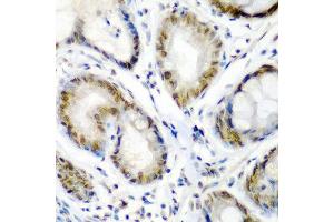 Immunohistochemistry of paraffin-embedded human colon carcinoma using SS18 antibody at dilution of 1:200 (40x lens). (SS18 Antikörper)